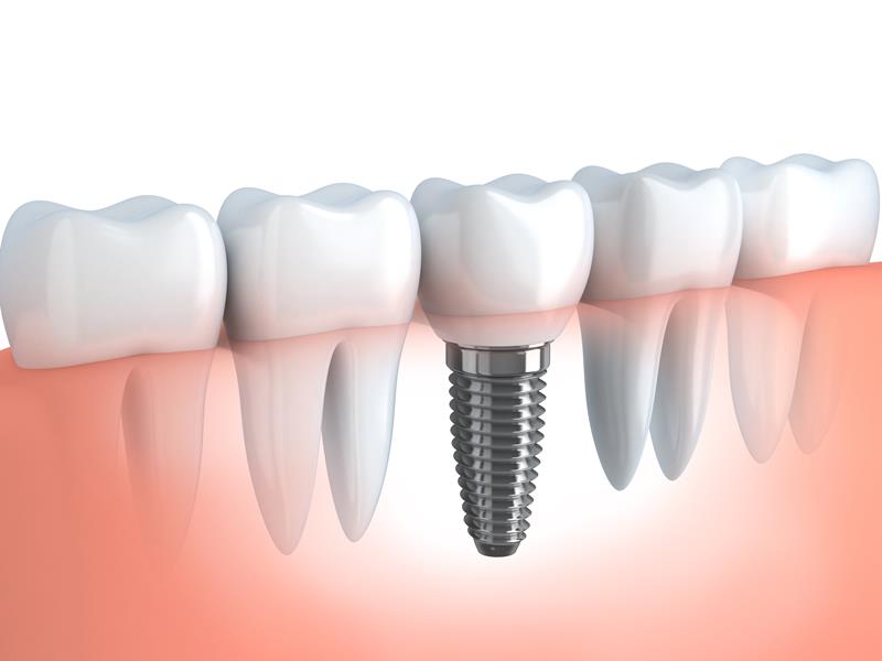 Dental Implants  Macclenny, FL 